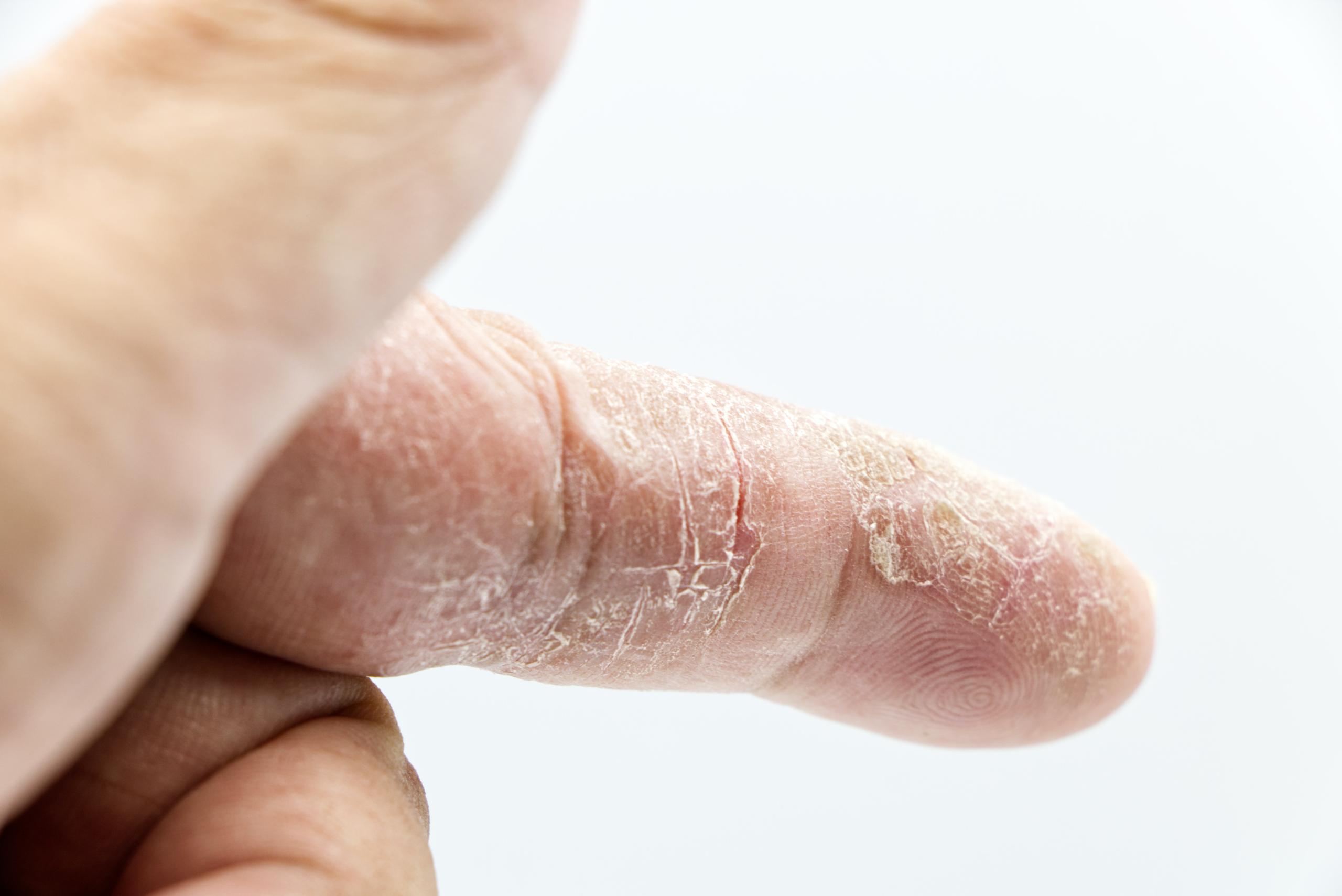 Dry Skin Dermatitis On A Finger