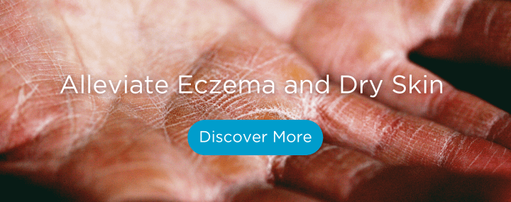 alleviate eczema and dry skin